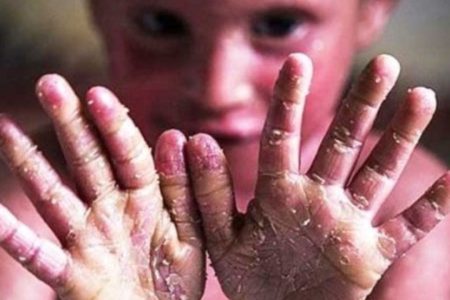  علت اصلی بیماری پروانه‌ای در ژن‌های کراتین و کلاژن است